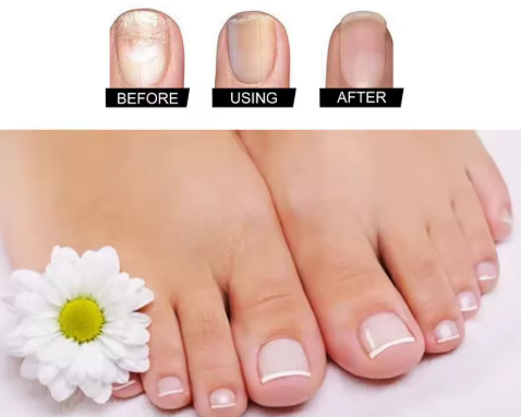 Gone Away™ - Gotero Antihongos