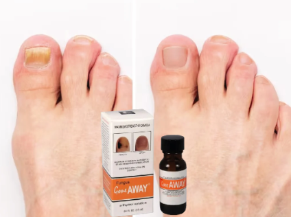 Gone Away™ - Gotero Antihongos – FemlyRD